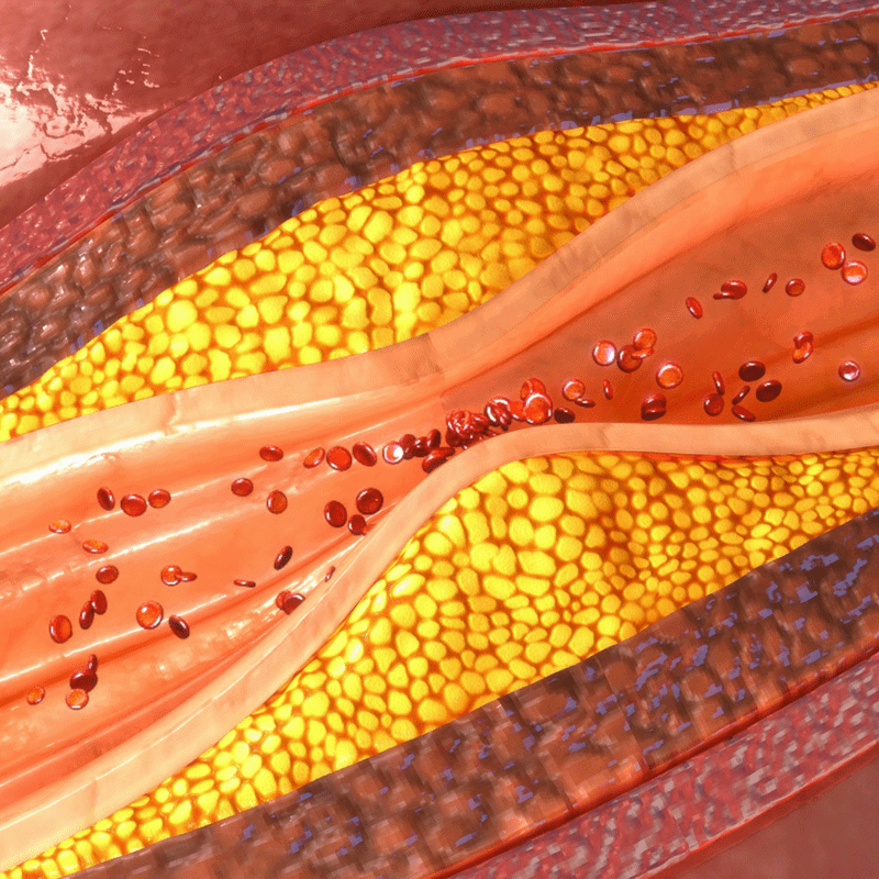 Arteries illustration for calcium buildup