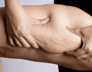 Supporting A Patient with Lipedema: A Comprehensive Metabolic Approach to Diagnosis and Treatment