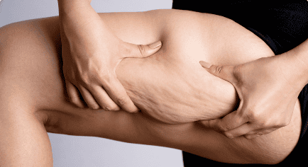 Supporting A Patient with Lipedema: A Comprehensive Metabolic Approach to Diagnosis and Treatment